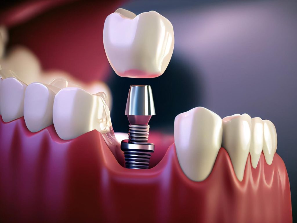 Dental Implant