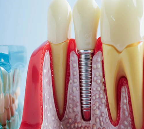 Root canal treatment