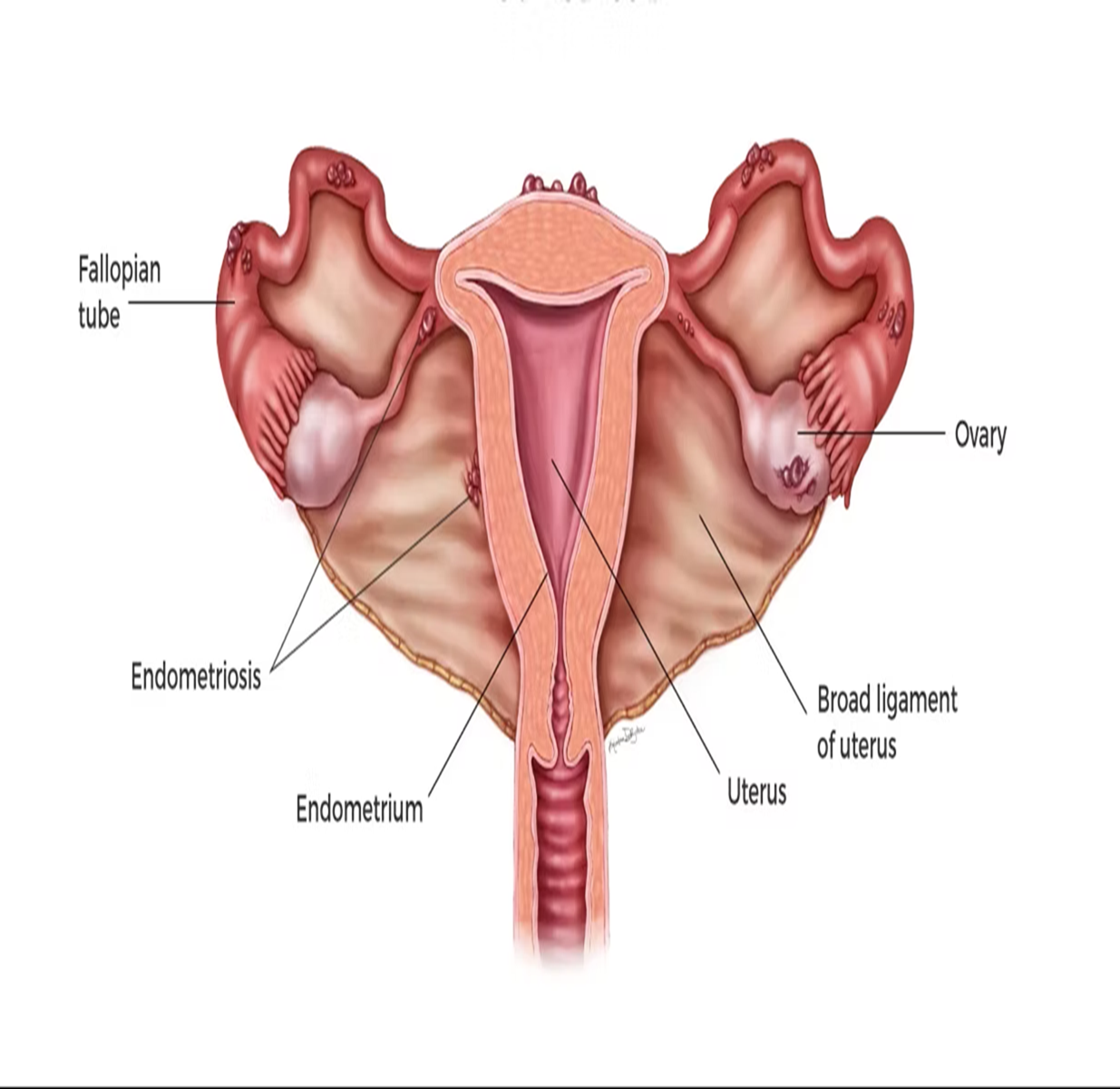 Endometriosis Treatment