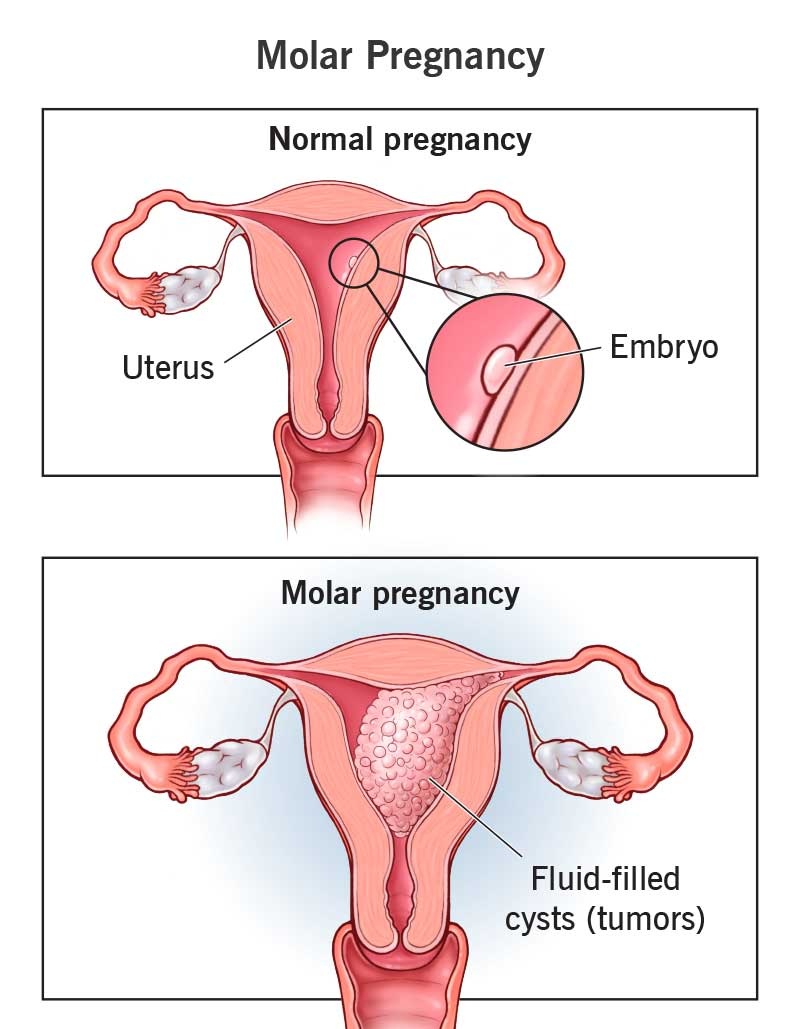 Molar Pregnancy Treatment